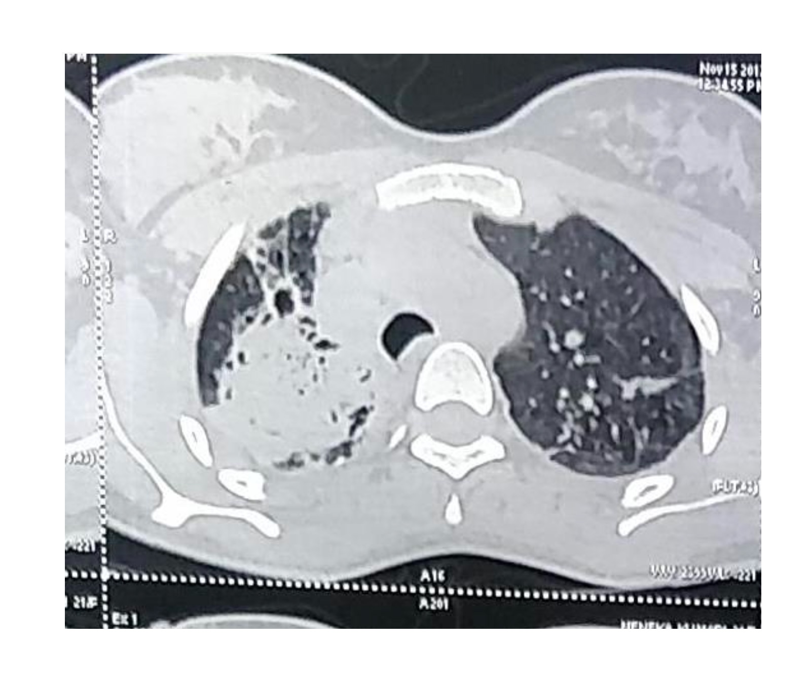 Aspergilloma Treatment Delhi