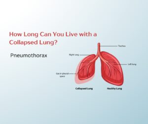 how long you can survive with a collapsed lung