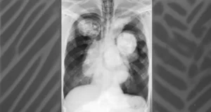 Understanding the Role of Pleural Effusion in Respiratory Diseases
